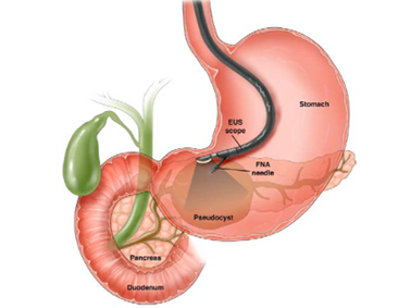 Capsule Endoscopy in Ahmedabad